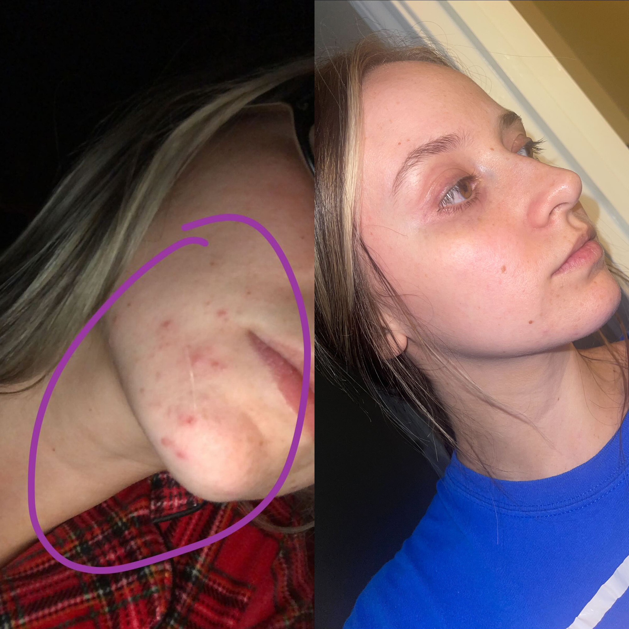 Hemp seed oil for skin with cystic acne on chin before and after image showing reduced acne breakouts